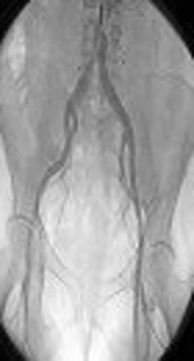 Comparison of ChitoHem Powder and Sand Bag for Controlling Bleeding After Femoral Angiography